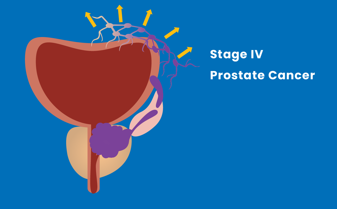 Stage IV prostate cancer illustration