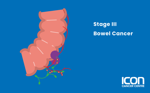 Stage III bowel cancer illustration