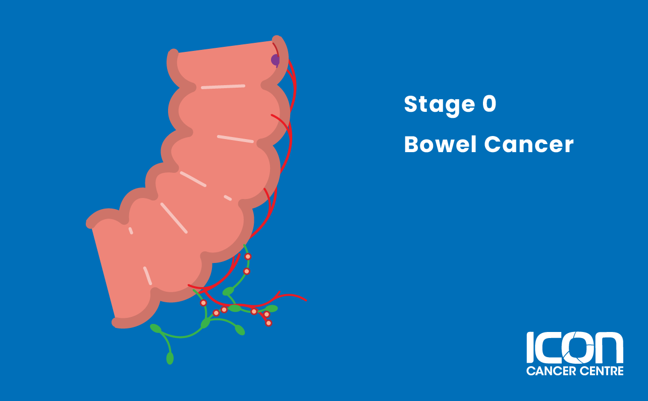 Stage 0 bowel cancer illustration