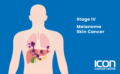 Stage IV melanoma illustration